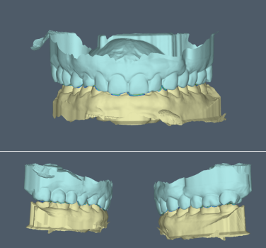 Modjaw™ - Static occlusion is not enough